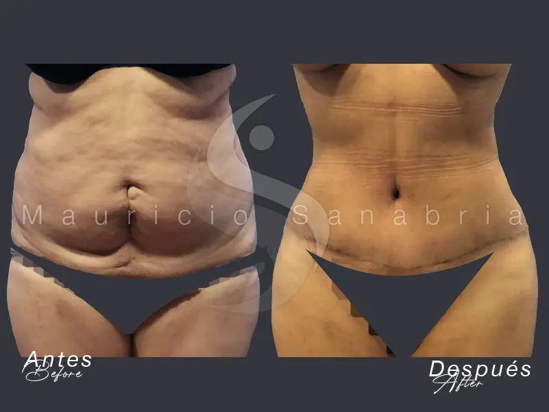 abdominoplasty