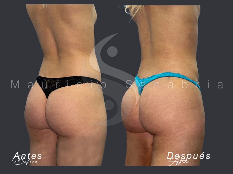 gluteoplasty